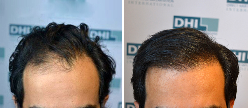 DHI before & after hair transplant results